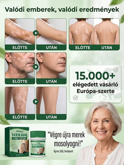 Bezhormonalny krem do pielęgnacji białych plam, szybkie działanie